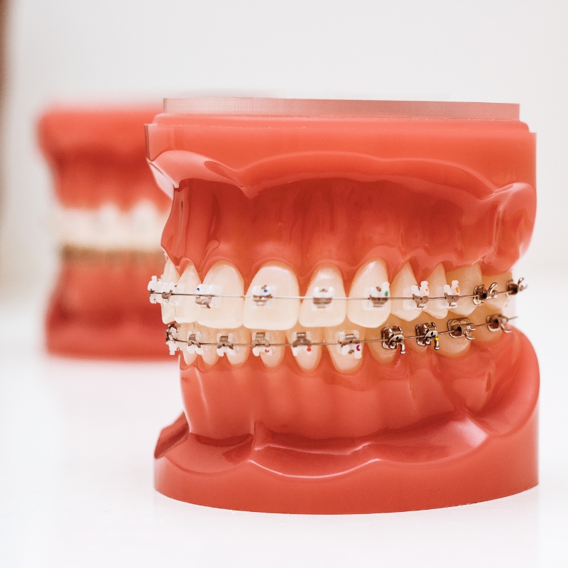 歯科矯正装置を付けた歯の模型