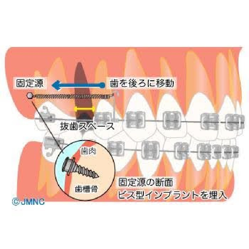 歯科矯正用アンカースクリューを用いた矯正歯科治療