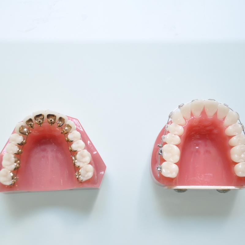 ハーフリンガル（舌側矯正）装置を付けた歯の模型