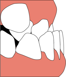 下顎前突の歯ならびイラスト