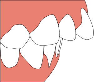 上顎前突歯ならびイラスト