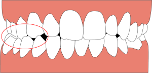 交叉咬合のイラスト